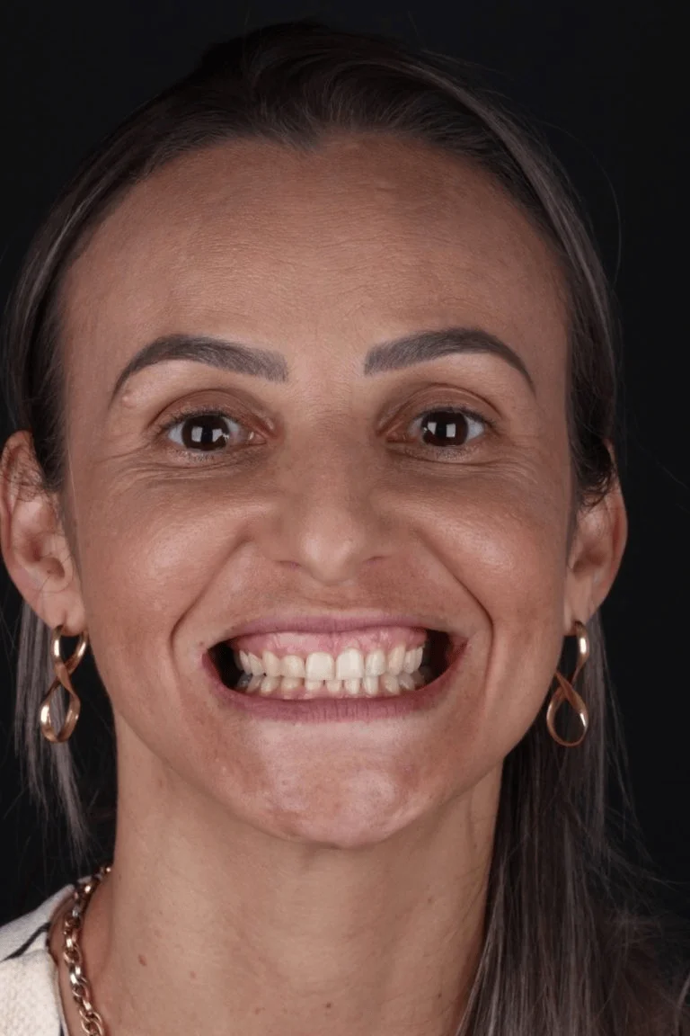 Antes